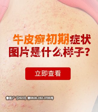 牛皮癬初期癥狀圖片是什么樣子？